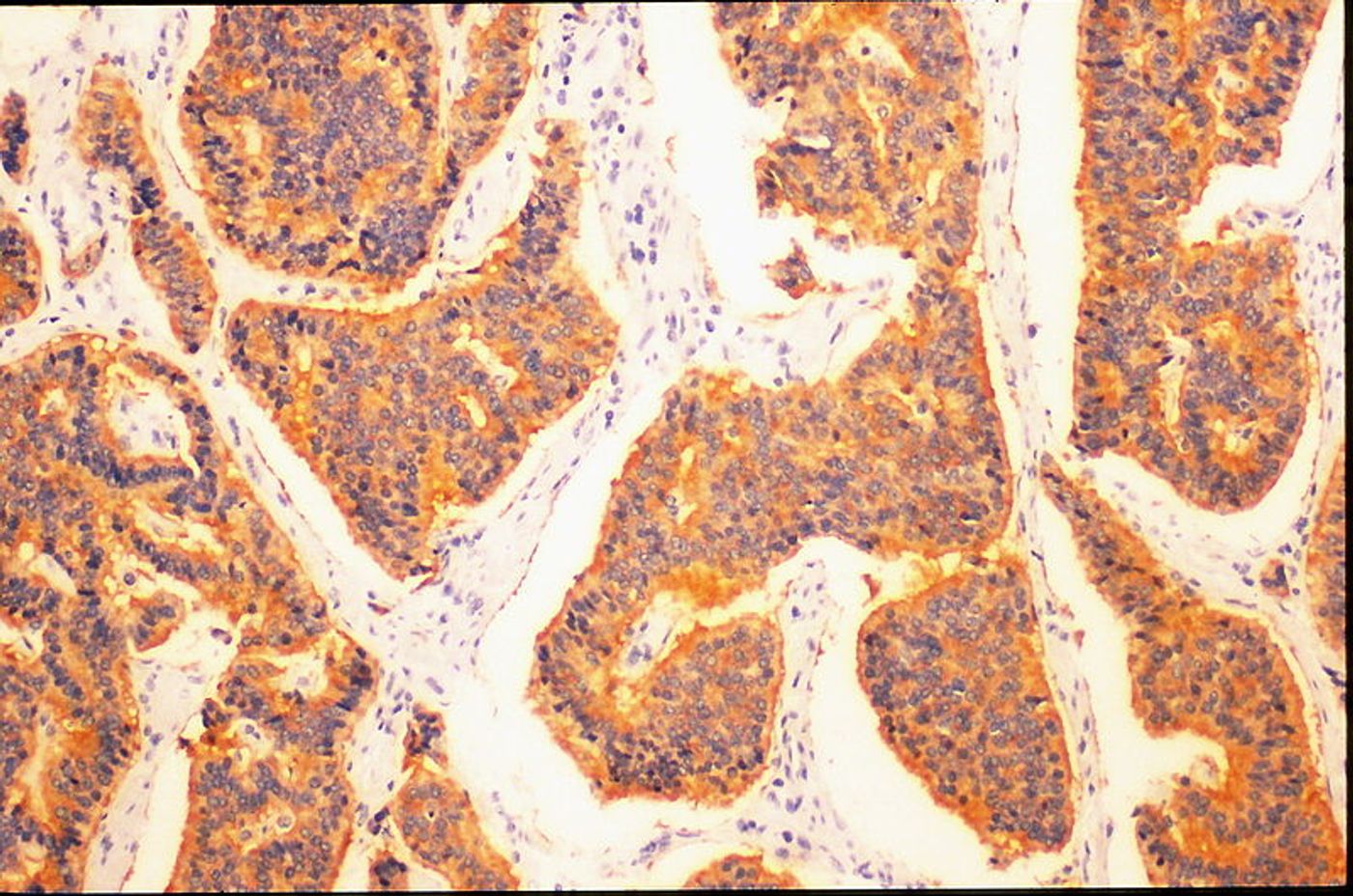 Histopathology of small cell lung carcinoma. Credit: Yale Rosen