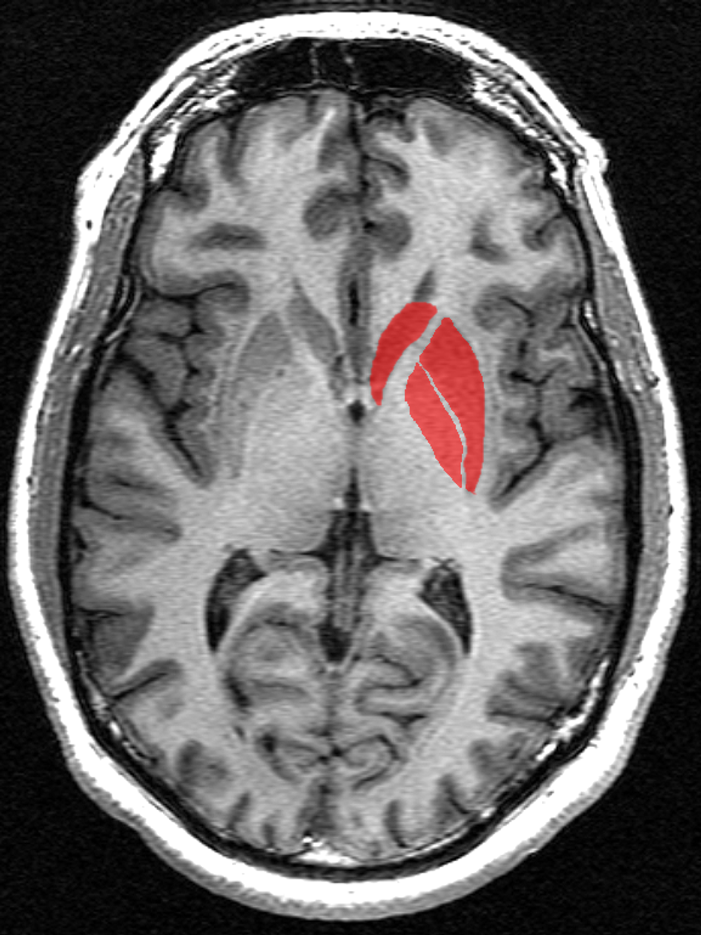 A transverse section of the striatum