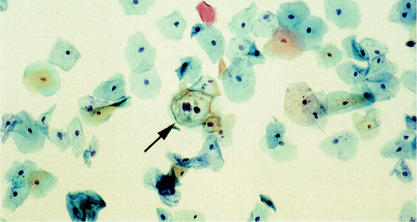 ThinPrep Pap Smear showing abnormal sqaumous cells with HPV cytopathic effect (arrow), consistent with LSIL.