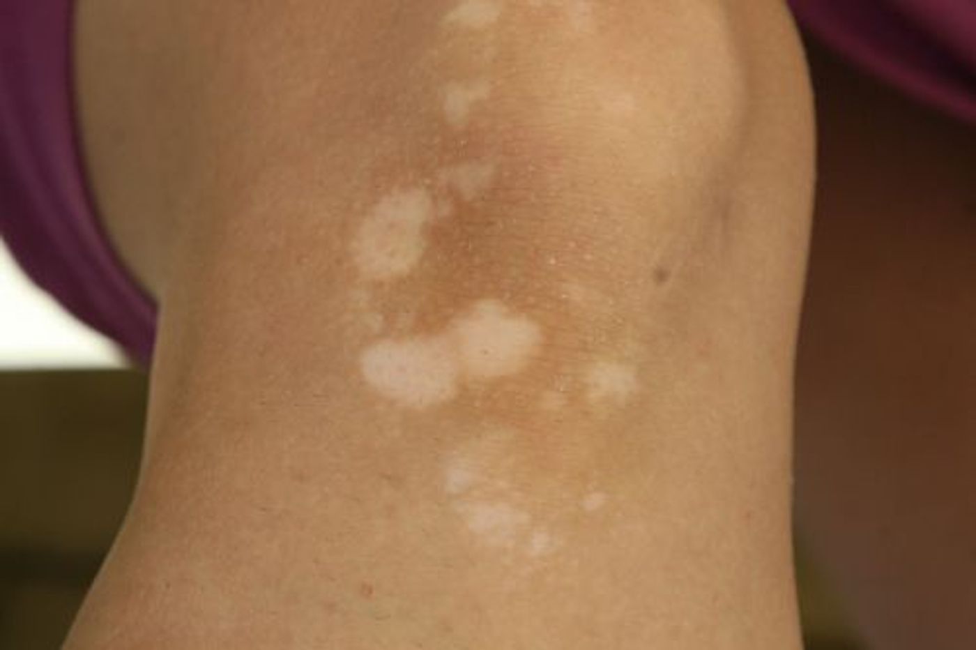 Tinea Versicolor, Diagnosis And Treatment