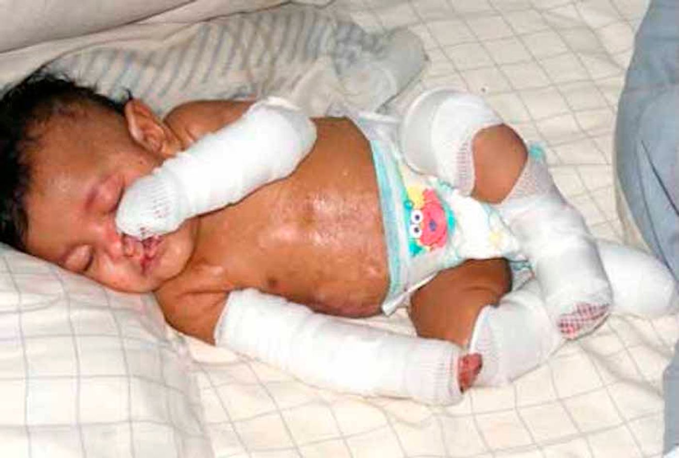 A baby with epidermolisis bullosa / Credit: Wikimedia Commons/Yovanna.Gonzalez