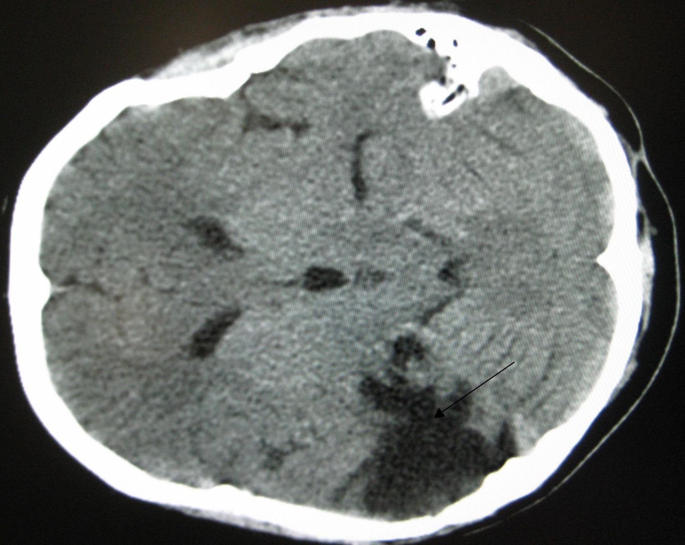 A CT of the head years after a traumatic brain injury showing an empty space marked by the arrow were the damage occurred. / Credit: Wikimedia Commons/ Author: James Heilman, MD