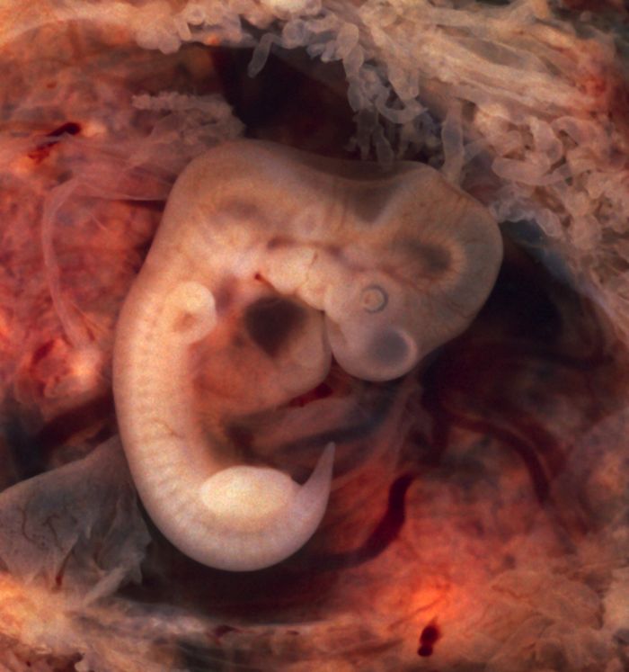 An opened oviduct with an ectopic pregnancy features a 10-millimeter embryo. Credit: Ed Uthman, MD.