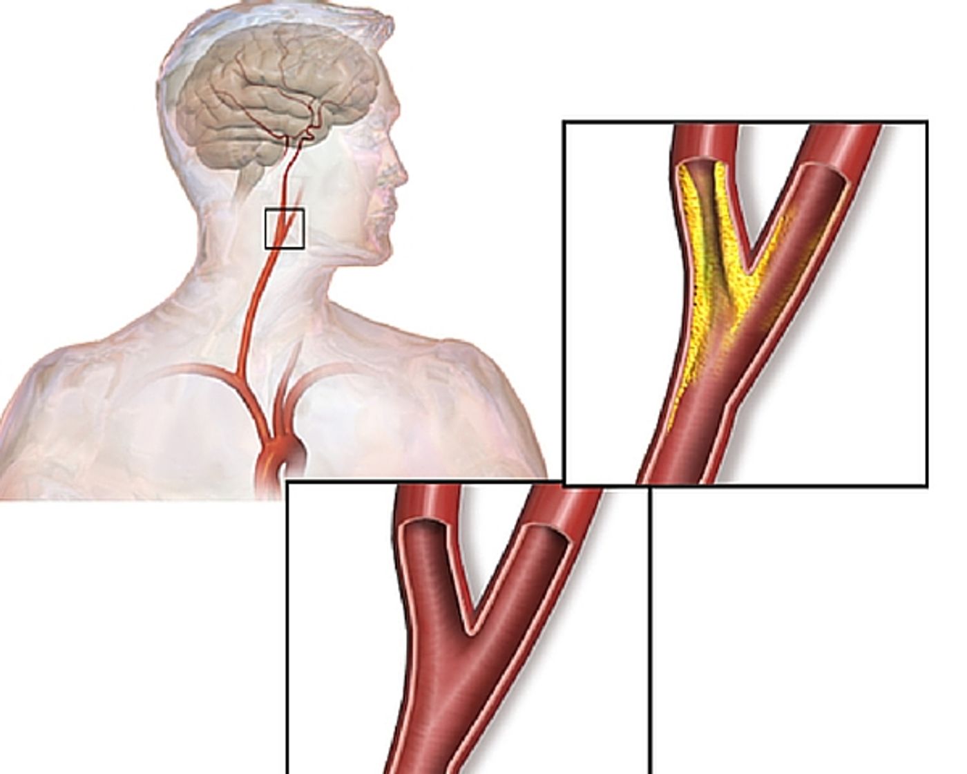 Stroke patients do better in hospitals with high volume