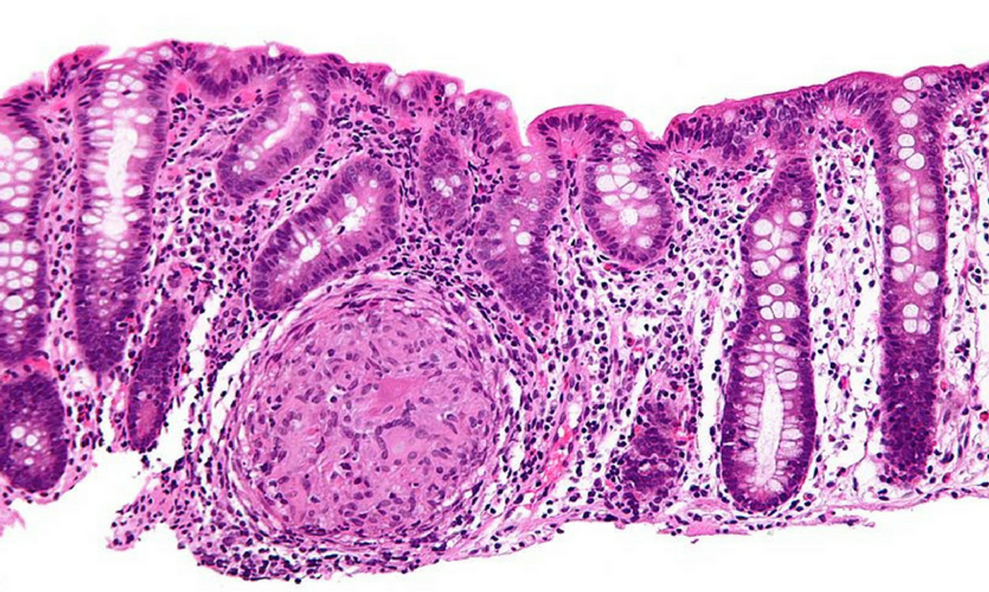 High magnification micrograph of Crohn's disease in the colon. Credit: Wikimedia user Nephron