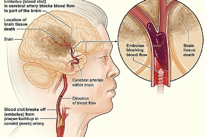 Time is crucial in getting treatment for a stroke