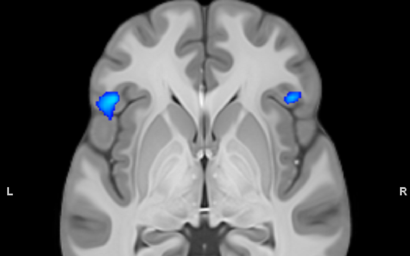 Fronto-insular regions of grey matter reduction in bipolar disorder. Credit: Wikimedia user Petergstrom