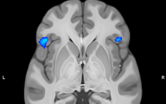 Fronto-insular regions of grey matter reduction in bipolar disorder. Credit: Wikimedia user Petergstrom