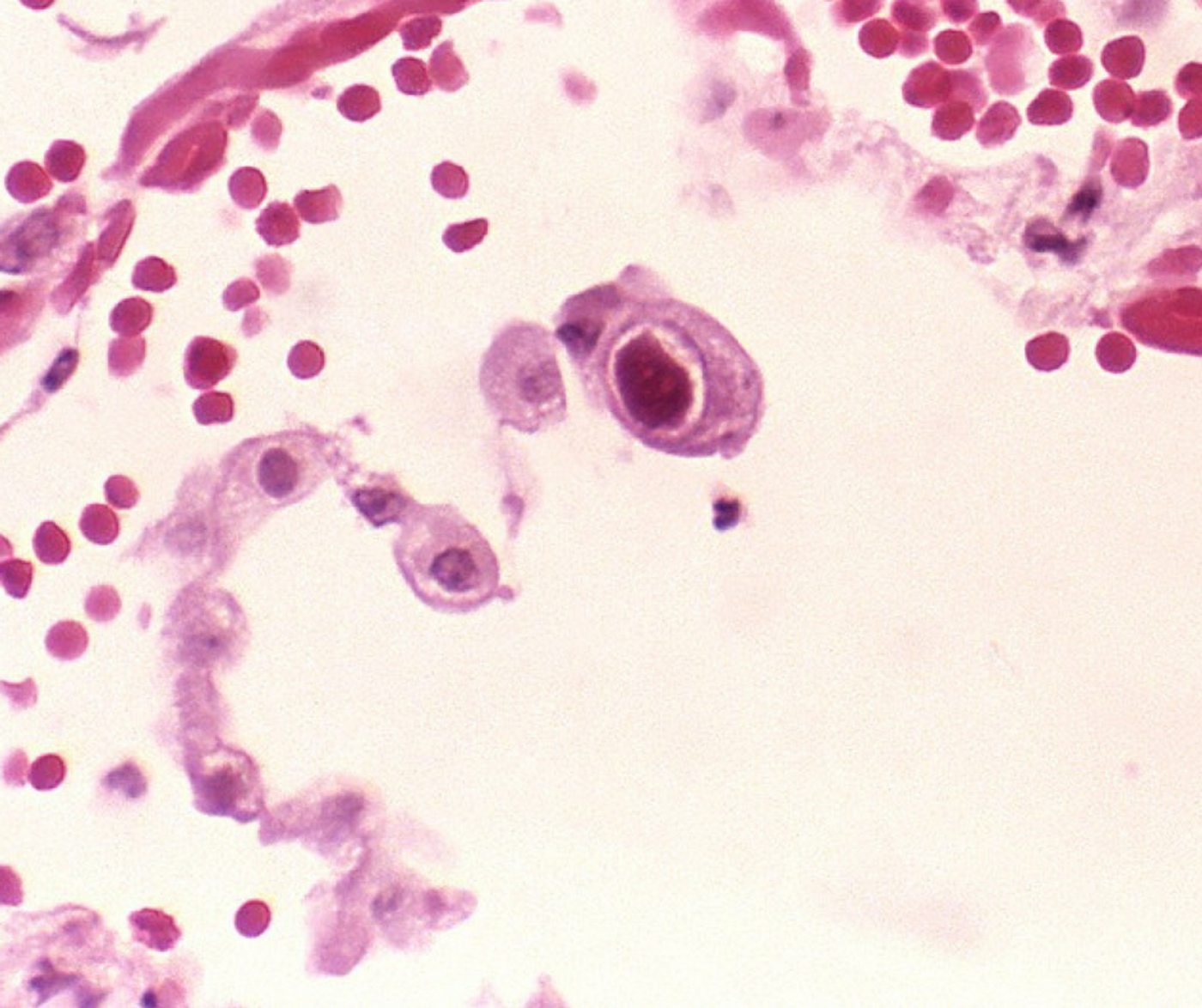 Cytomegalovirus infection of a lung cell. Credit: CDC Public Health Image Library