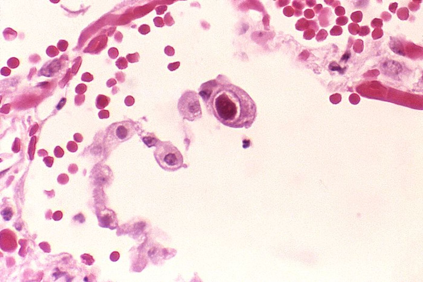 Cytomegalovirus infection of a lung pneumocyte./ Credit: CDC Public Health Image Library