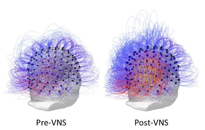 This figure shows information sharing across all electrodes before and after vagus nerve stimulation (VNS). On the right, the warmer colors (yellow/orange) indicate an increase of connectivity among posterior parietal regions. / Credit: Corazzol et al.