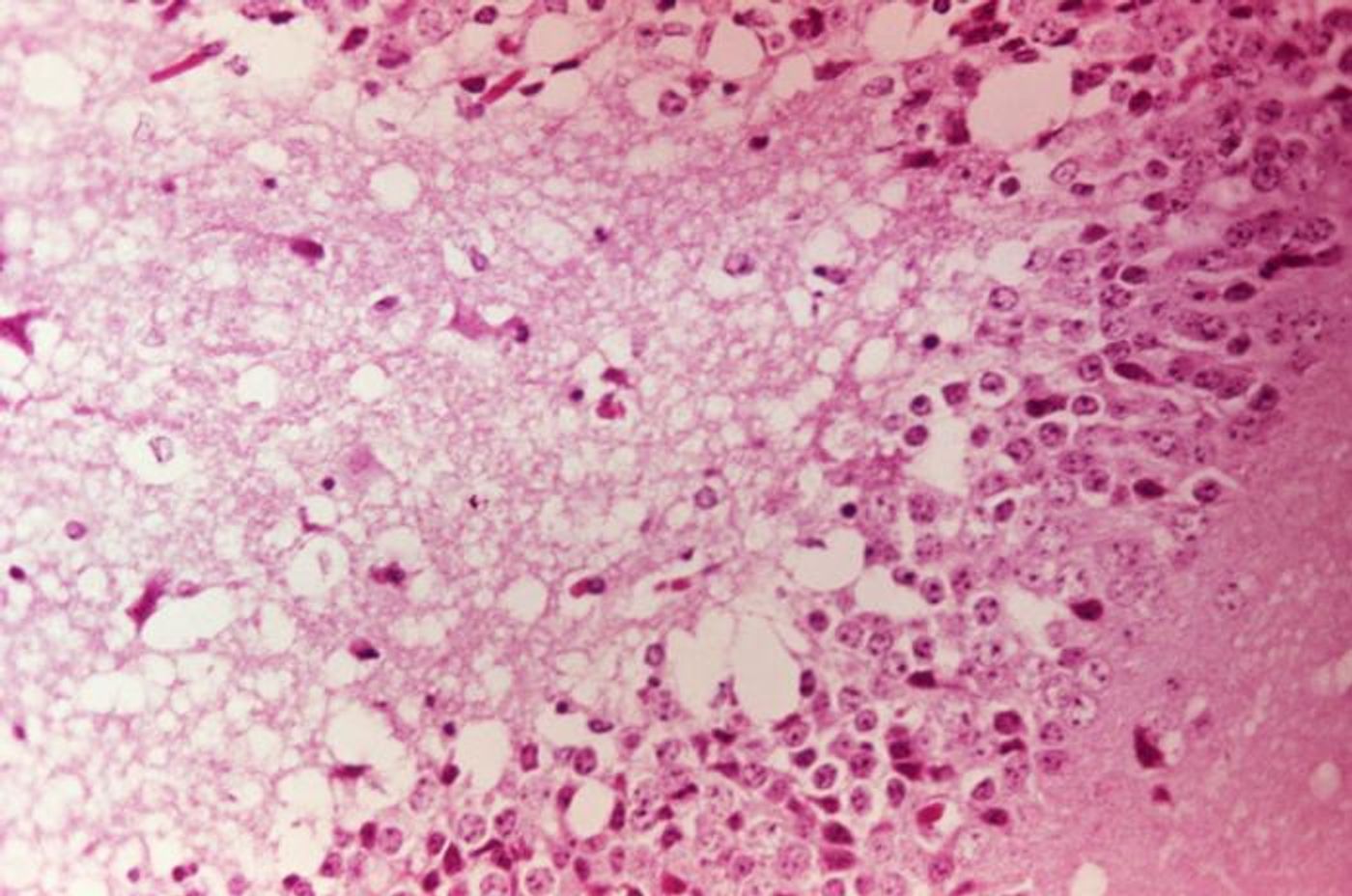 Photomicrograph of mouse brain tissue after dying of Venezuelan Encephalitis. Reveals neural necrosis and edema. /Credit: CDC's Public Health Image Library (PHIL)