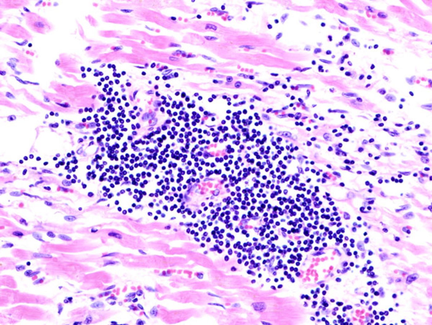 Microscopic image of inflamed heart muscle tissue. Credit: Bell Rap