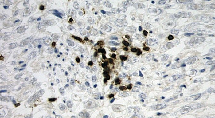 T-lymphocytes within myocardium. Credit: Westgate Research Team
