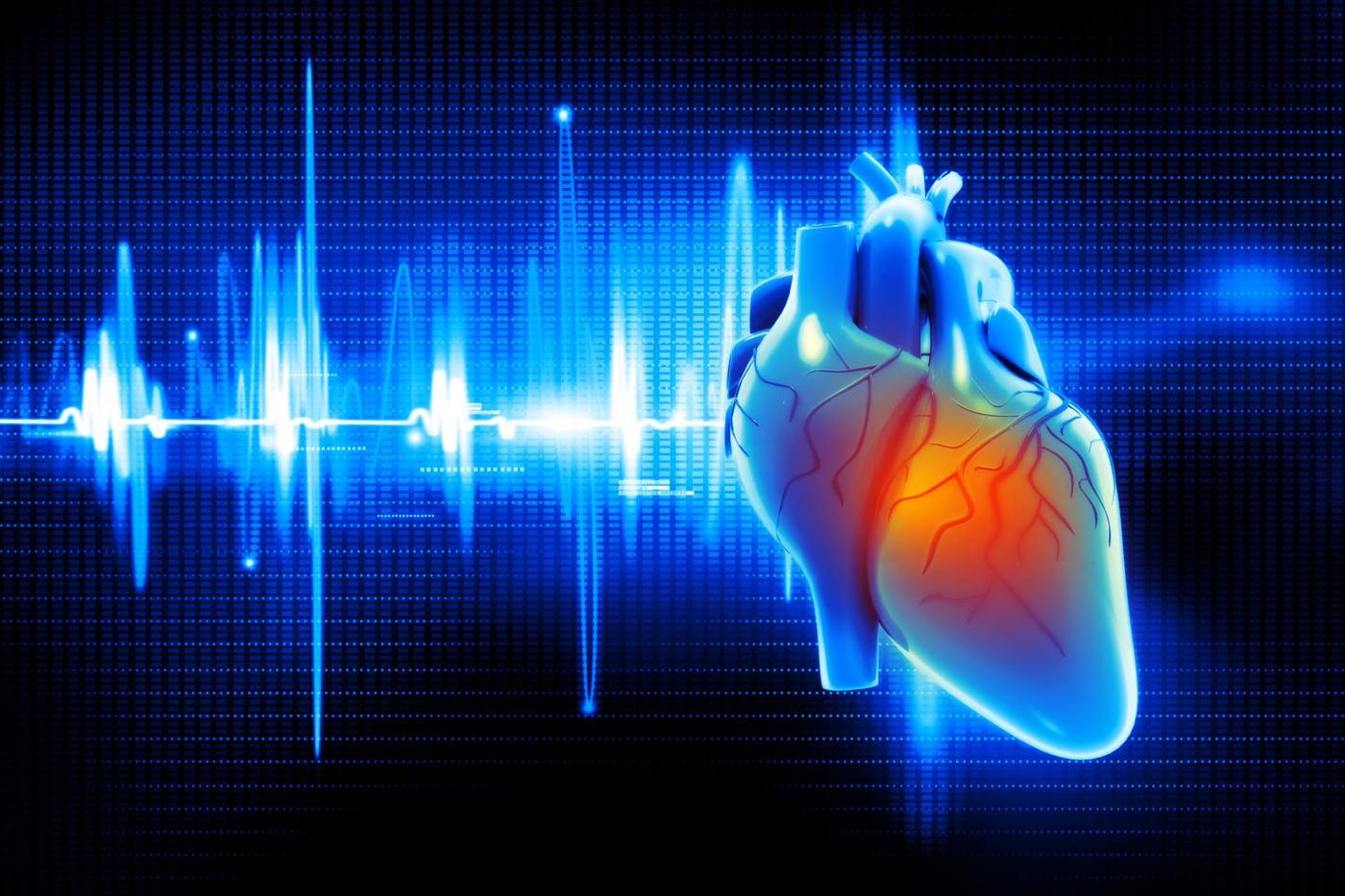 Researchers have identified a microRNA biomarker that demonstrates a strong association with the incidence of atrial fibrillation, the most common abnormal heart rhythm. Intermountain Medical Center Heart Institute