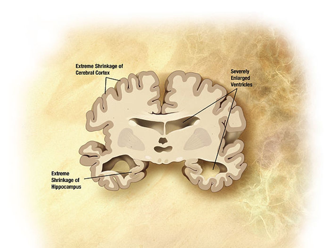 Areas of the brain impacted by Alzheimer's Disease