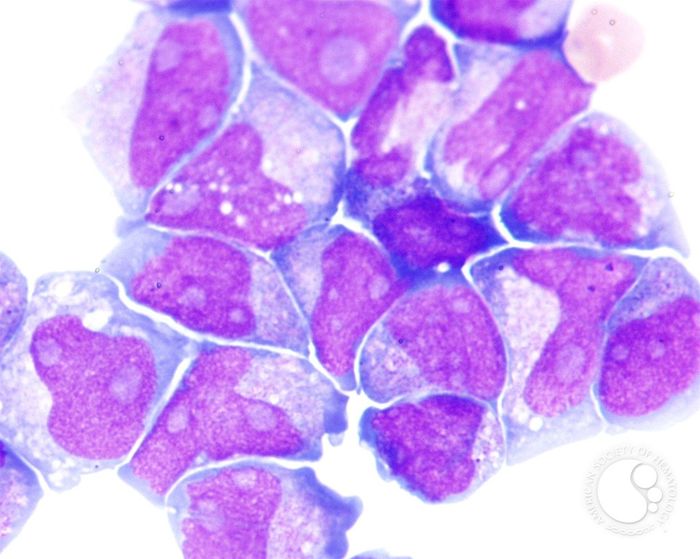 A high power view of AML with multilineage dysplasia. Source: American Society of Hematology