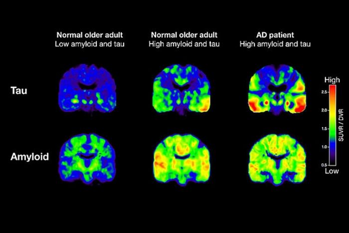 Brain scans showing amyloid and tau deposits