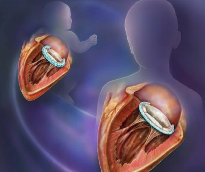 A new growth-accommodating medical implant could reduce the amount of invasive surgeries needed to mend heart defects. Credit: Randal McKenzie, BWH