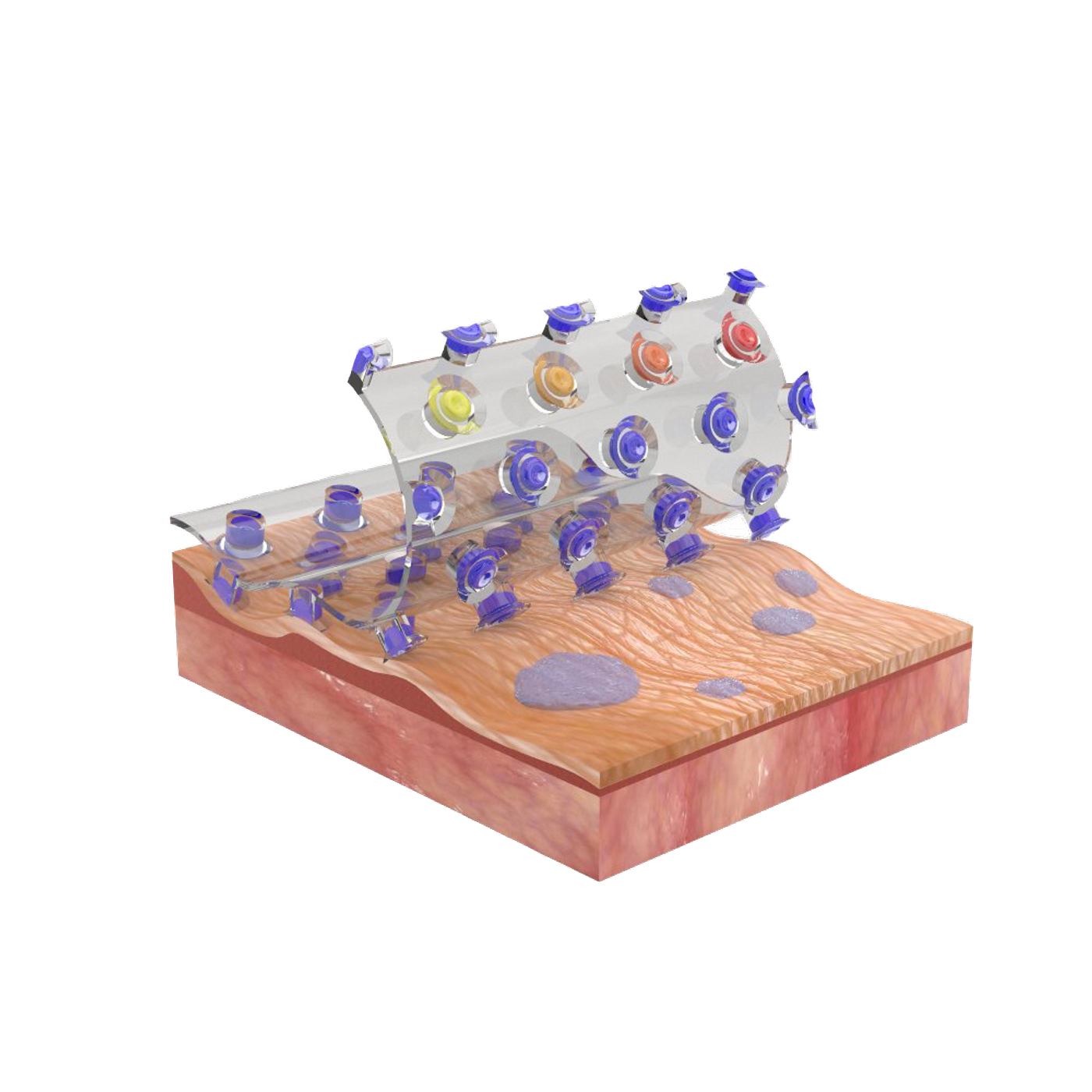 Schematic illustration of the adhesive patch with diving beetle-inspired suction chambers against rough and wet human skin. ©McGill University