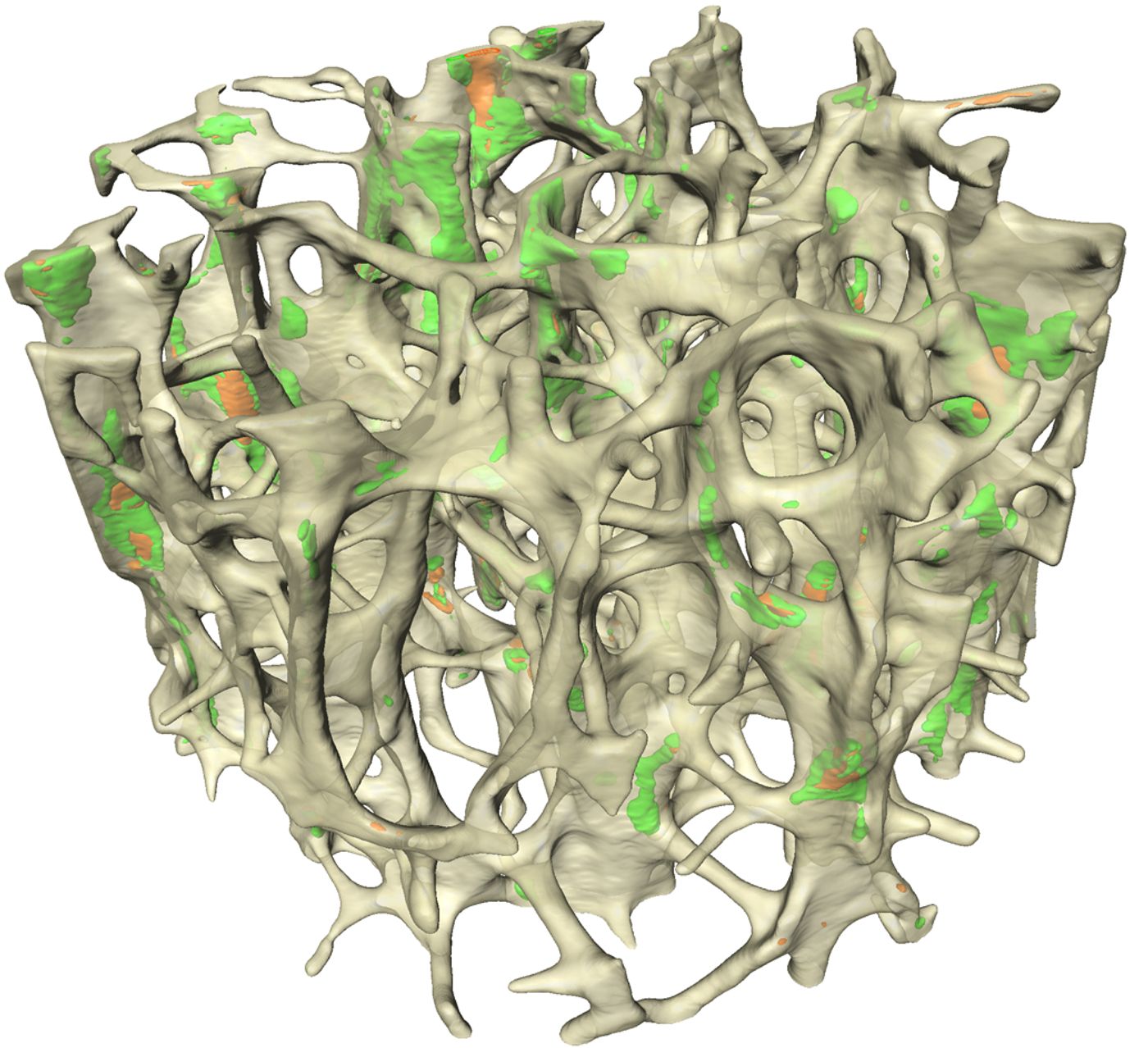 Cancellous bone. Regions of microscopic tissue damage shown in green and orange