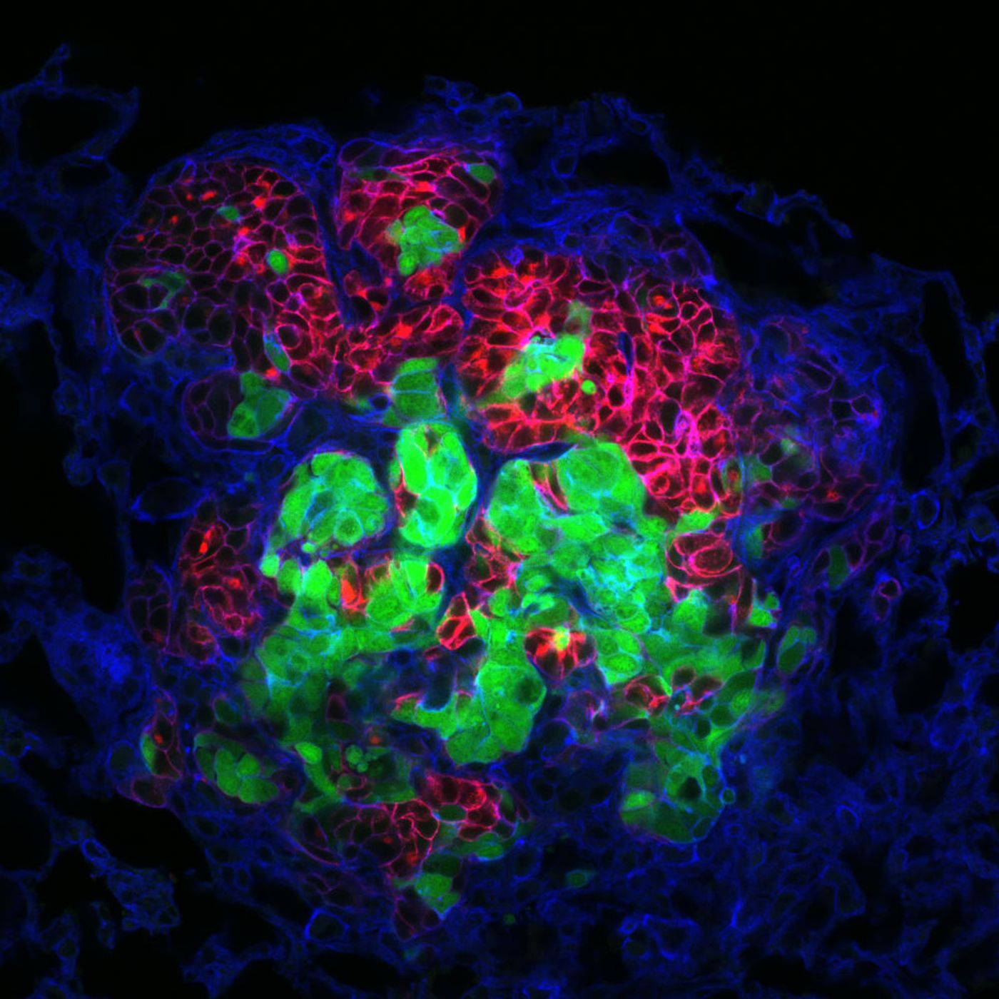 A metastasis now growing in lung tissue (blue) that originated from at least two cells (red and green) from a multicolored tumor in the mammary gland of a mouse.