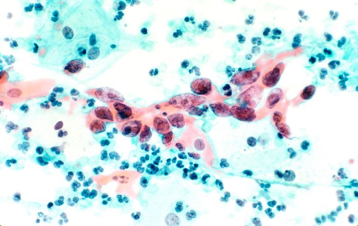 Cytological specimen showing cervical cancer specifically squamous cell carcinoma in the cervix. Tissue is stained with pap stain and magnified x200. / Credit: National Cancer Institute