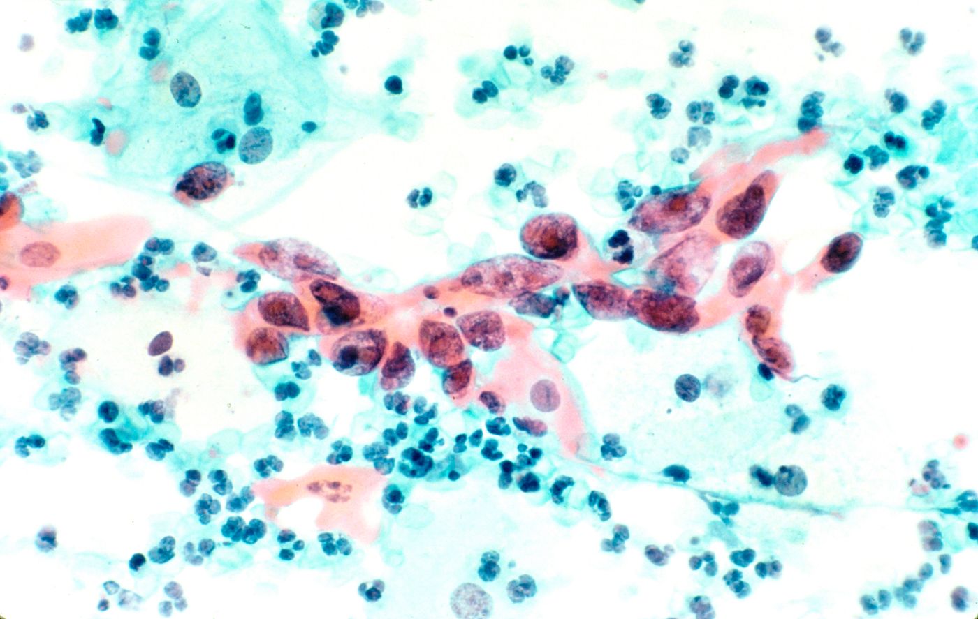 Cytological specimen showing cervical cancer specifically squamous cell carcinoma in the cervix. Tissue is stained with pap stain and magnified x200. / Credit: National Cancer Institute