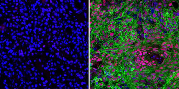 Researchers found that two types of non-small cell lung cancer metabolize glucose differently. There is a lot more GLUT1, (green), in lung squamous cell carcinoma cells (right) compared with lung adenocarcinoma cells (left). / Credit: University of Texas at Dallas