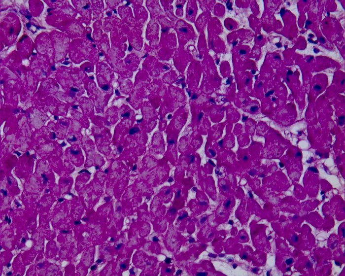 PAS stain of normal cardiomyocytes. Credit: Humpath.com