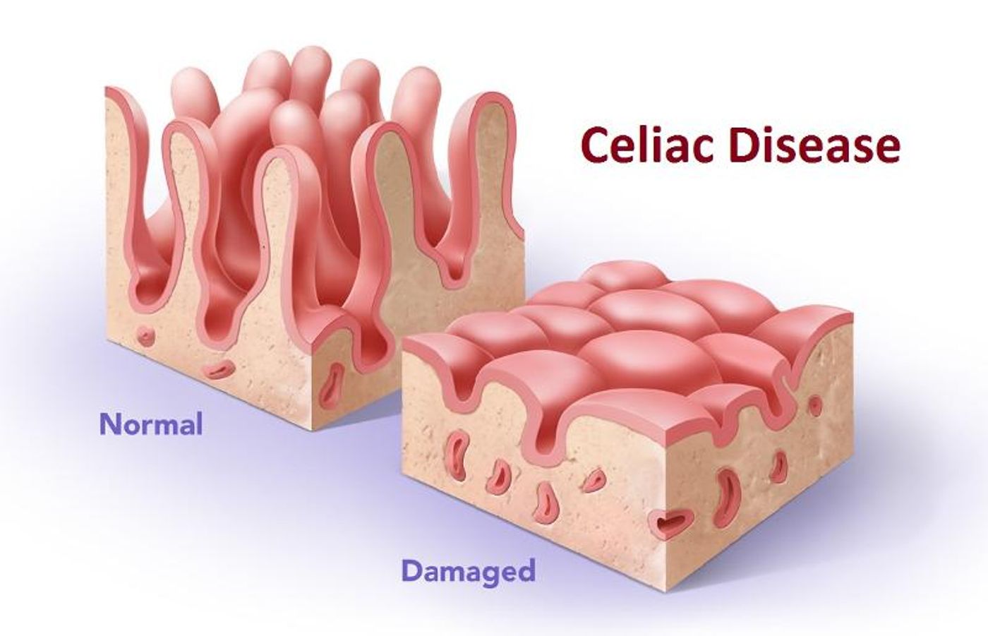 Damaged enterocytes and villi 