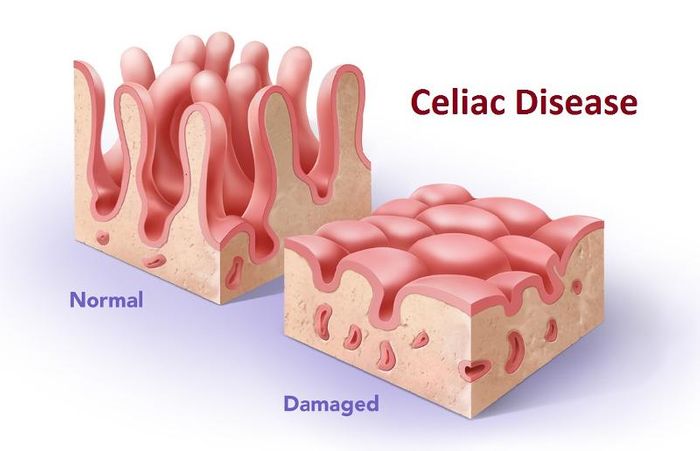 Damaged enterocytes and villi