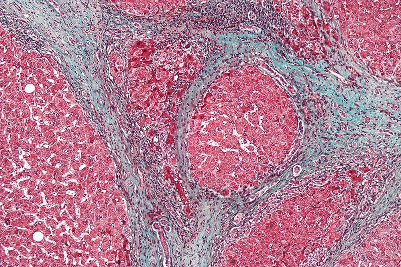 High magnification micrograph of a liver with cirrhosis. / Credit: Wikimedia Commons/Nephron