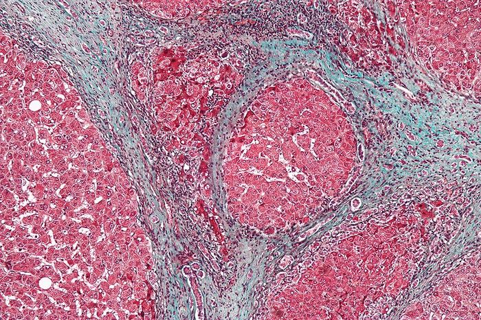 High magnification micrograph of a liver with cirrhosis. / Credit: Wikimedia Commons/Nephron