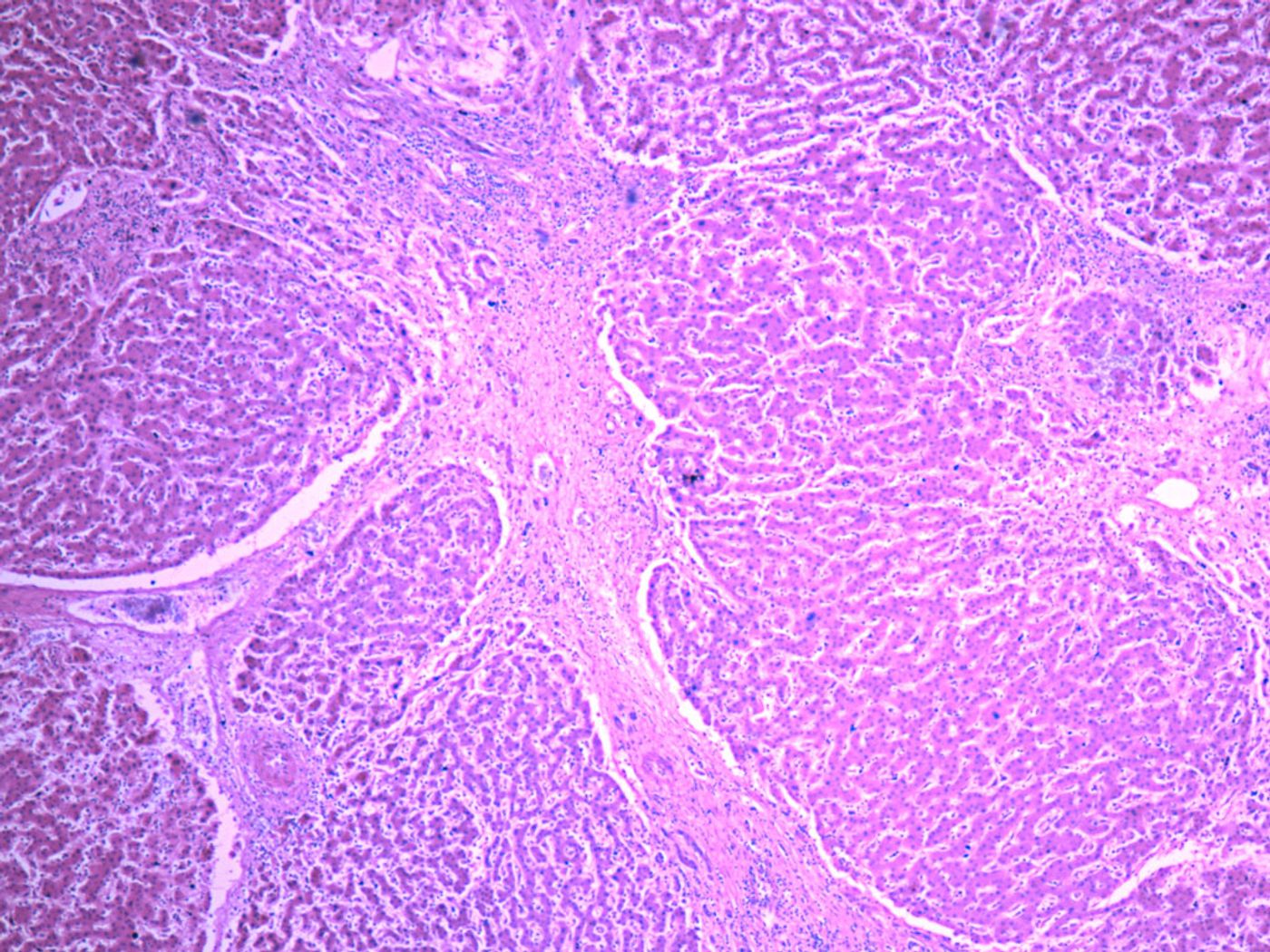 Damaged liver tissue due to cirrhosis | Image: Yale