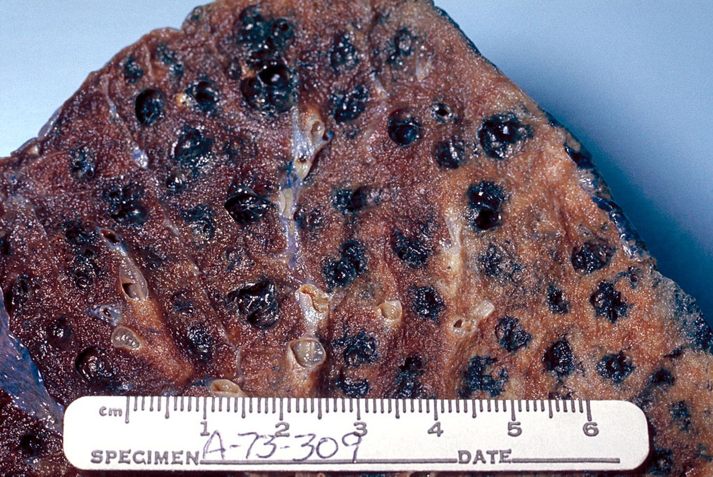 Gross pathology of lung showing centrilobular emphysema characteristic of smoking. Closeup of fixed, cut surface shows multiple cavities lined by heavy black carbon deposits. / Credit: Wikimedia/Dr. Edwin P. Ewing, Jr.
