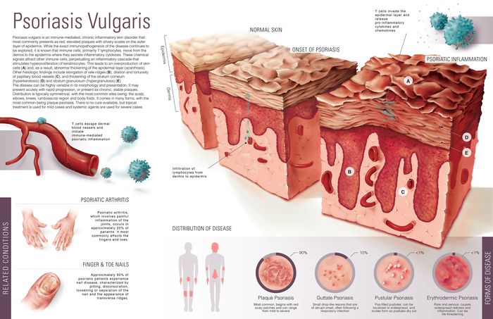 psoriasis heart failure