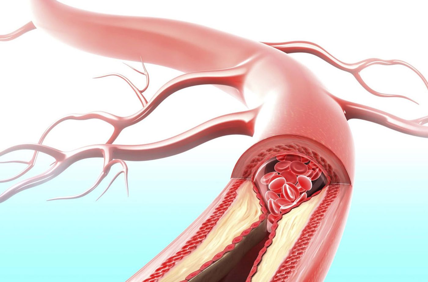 Plaque buildup blocking blood flow