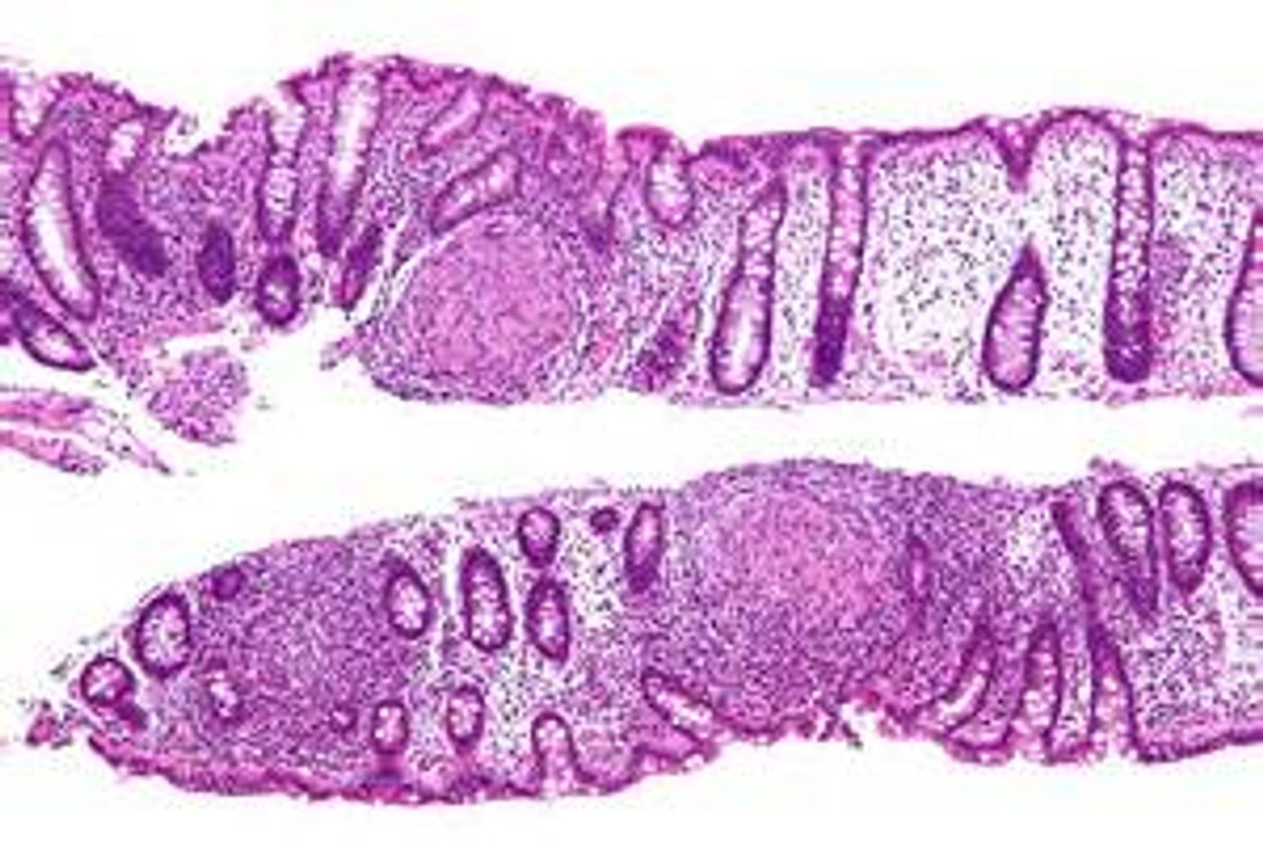 A colon showing intermediate magnification micrograph of Crohn's disease from a colon biolpsy and H&E stain. (Public Domain)