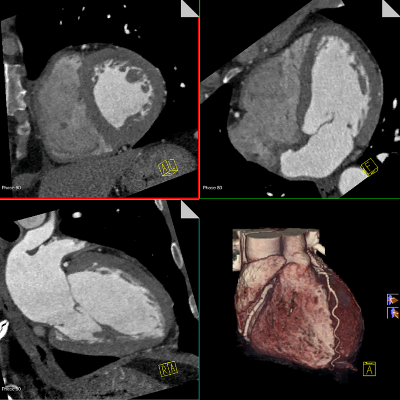Coronary CT angiography (CCTA) is a noninvasive imaging modality which can be used to evaluate the anatomy of the coronary arteries. Credit: Clinical Correlations