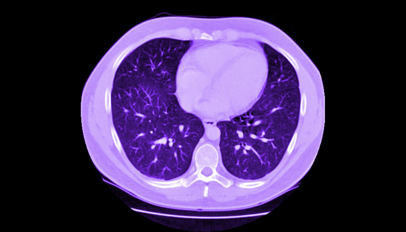 "No test is 100 percent accurate 100 percent of the time, but our findings indicate CT angiograms get pretty close to that coveted threshold," says Armin Zadeh.
