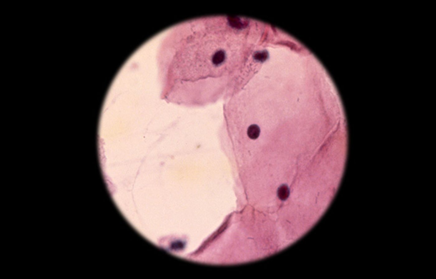 A cytologic smear under the microscope / Credit: QMUL