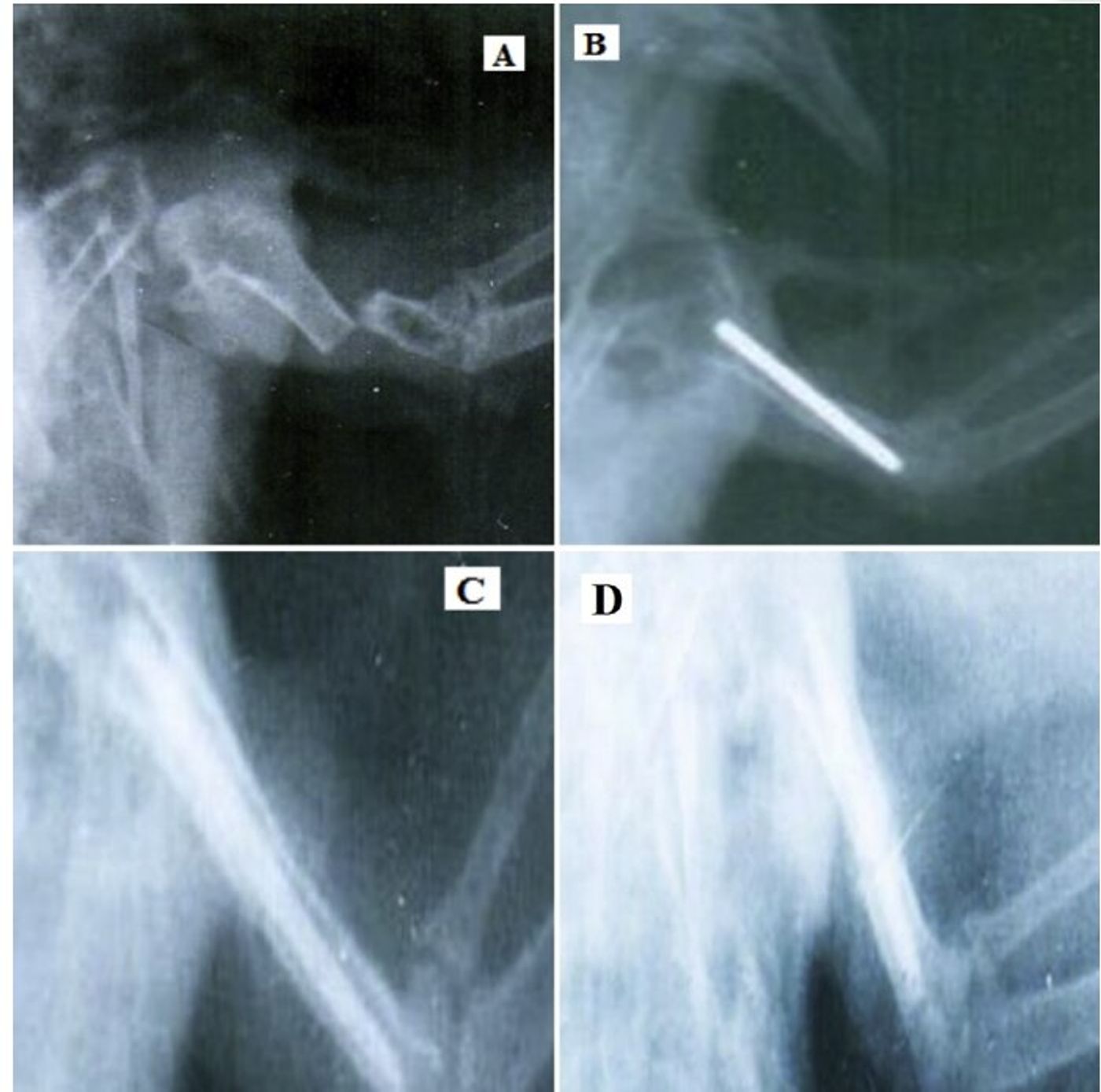 Bone-based pins are used to help brace a bird's fractured wing bone.