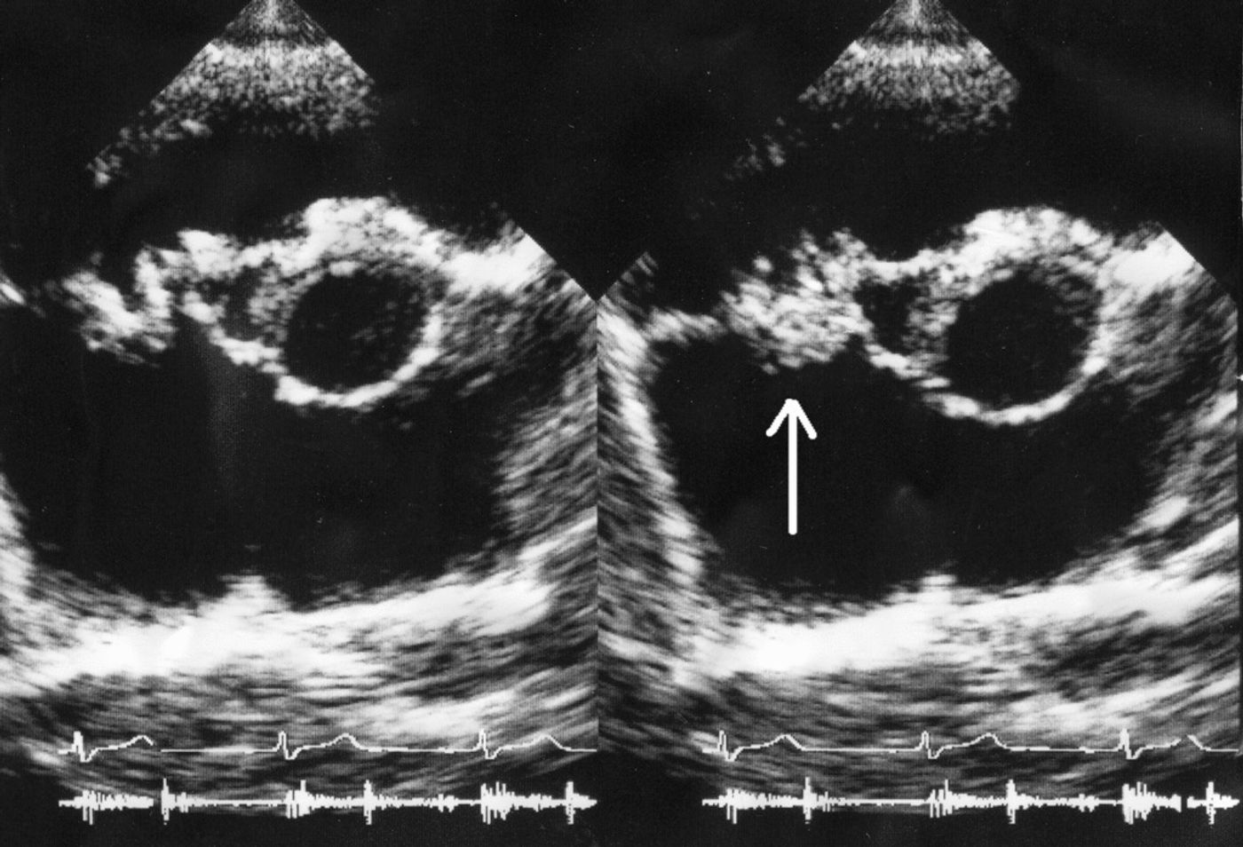 An endocarditis ultrasound; vegetation on tricuspid valve by echocardiography. Source: Boundless