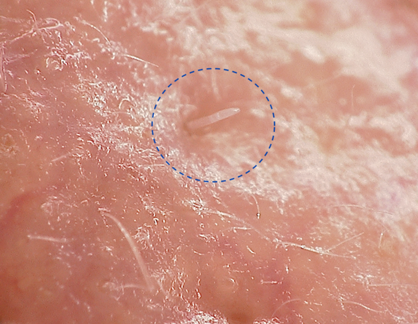 Image showing Demodex folliculorum mite on skin under Hirox microscope / Credit : University of Reading
