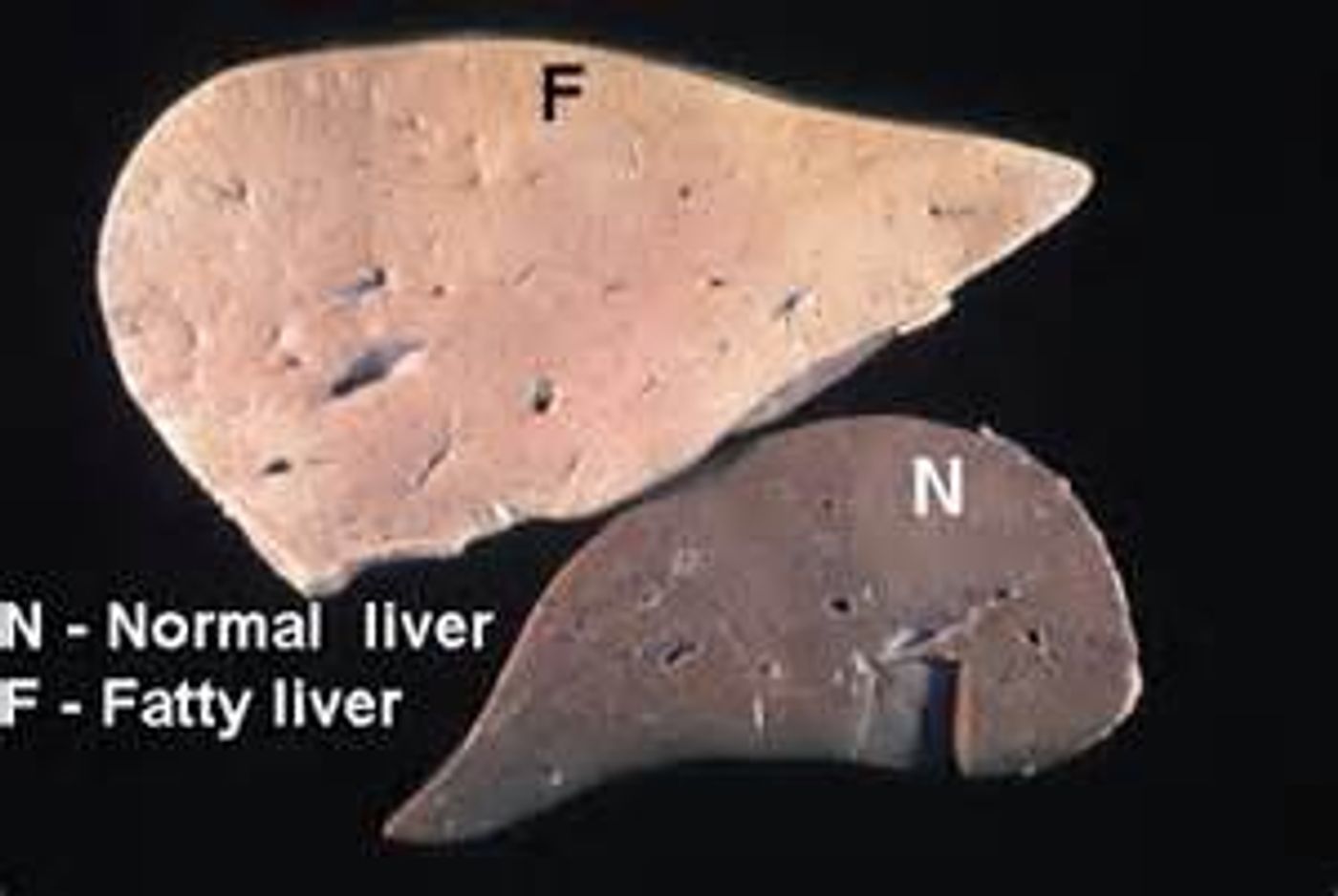 An example of a healthy liver compared with an enlarged fatty liver.