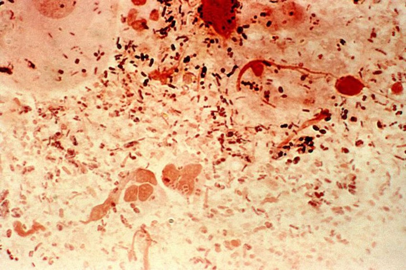 Gonorrhea Neisseria / Credit: pixnio/Joe Miller, USCDCP