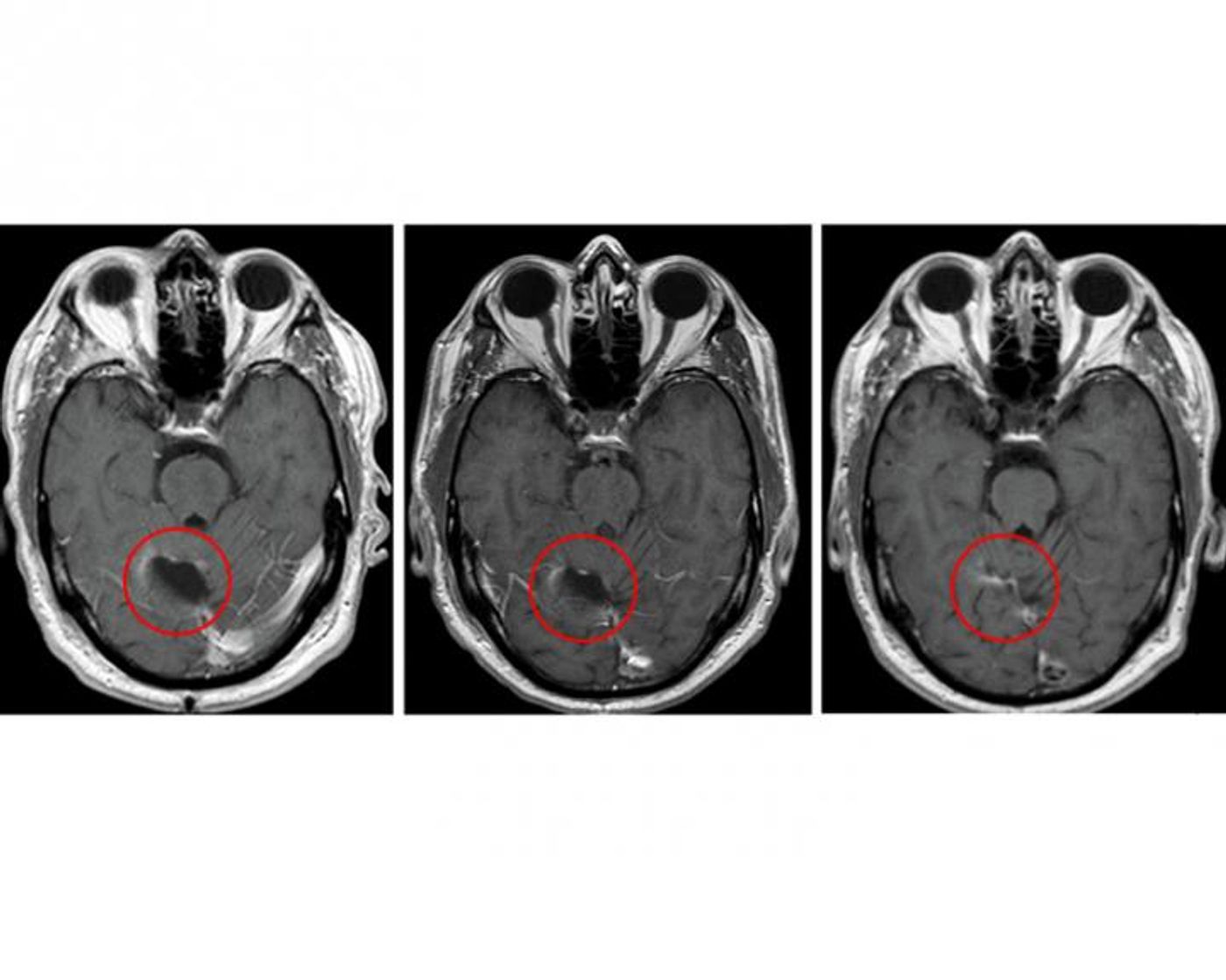 Brain scans from the study's glioblastoma trial.  Credit: Clinical Cancer Research/American Association for Cancer Research