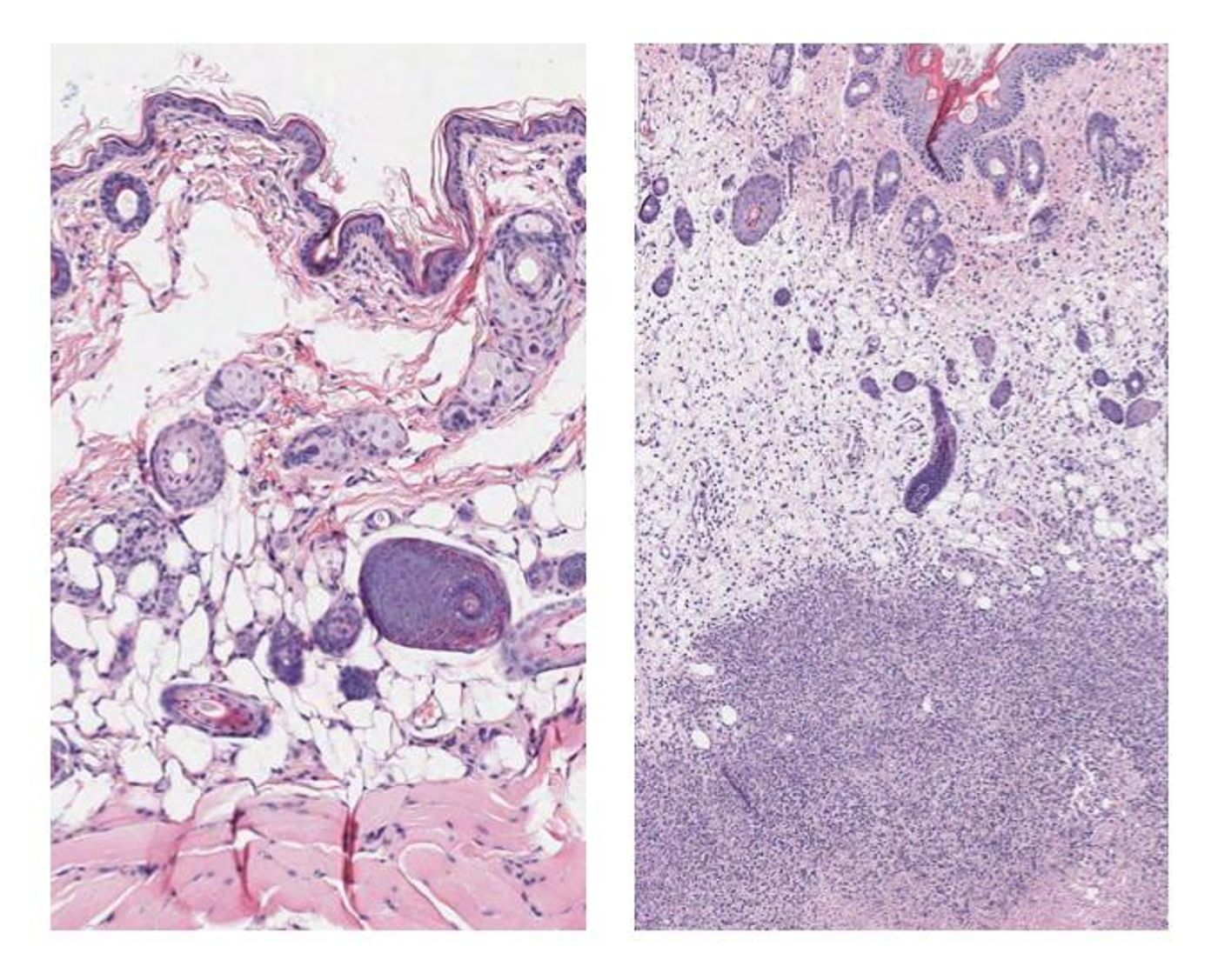 Tissue staining shows group A Streptococcus soft tissue infection at the cellular level. (L-R) Uninfected mouse tissue and mouse tissue 48 hours after infection. The dense dots indicate immune system cells that swarmed in to attempt to control the infection. The densest purple staining toward the bottom is necrotic tissue surrounding bacteria. / Credit: Joshua Leiberman, University of Maryland Baltimore