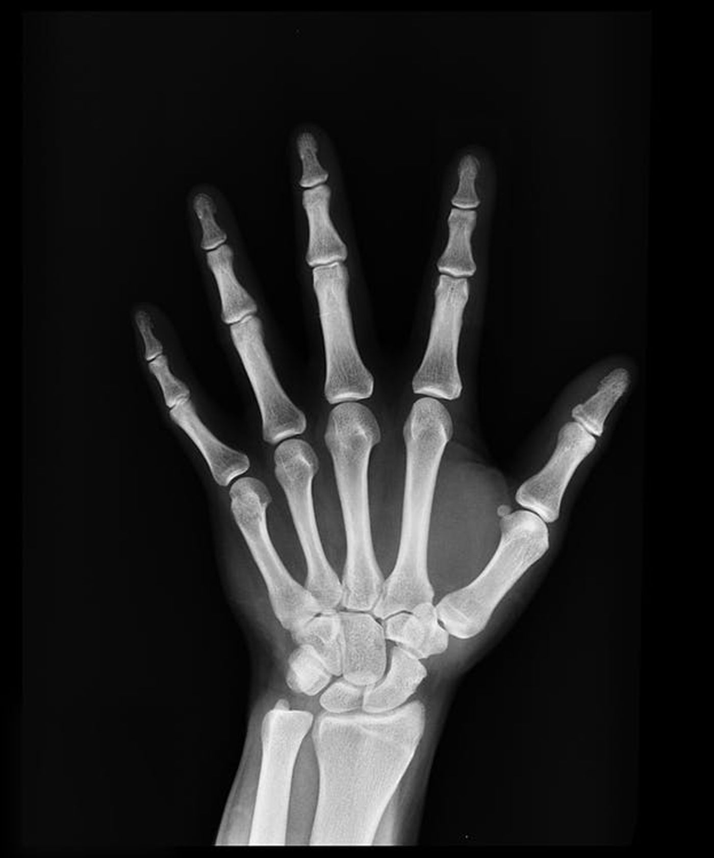 hand X-ray, credit: public domain